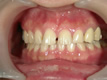 審美歯科治療例B